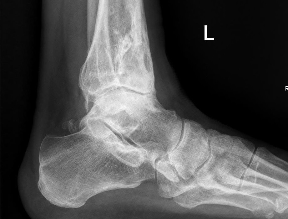 Kritisch loterij helpen Artrose voet en enkel - Operatie - Orthopedie Roeselare