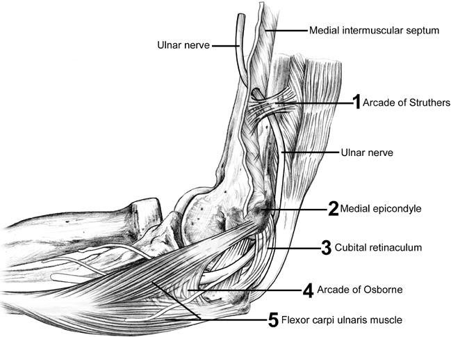 A pinched nerve in the elbow - Orthopedie Roeselare